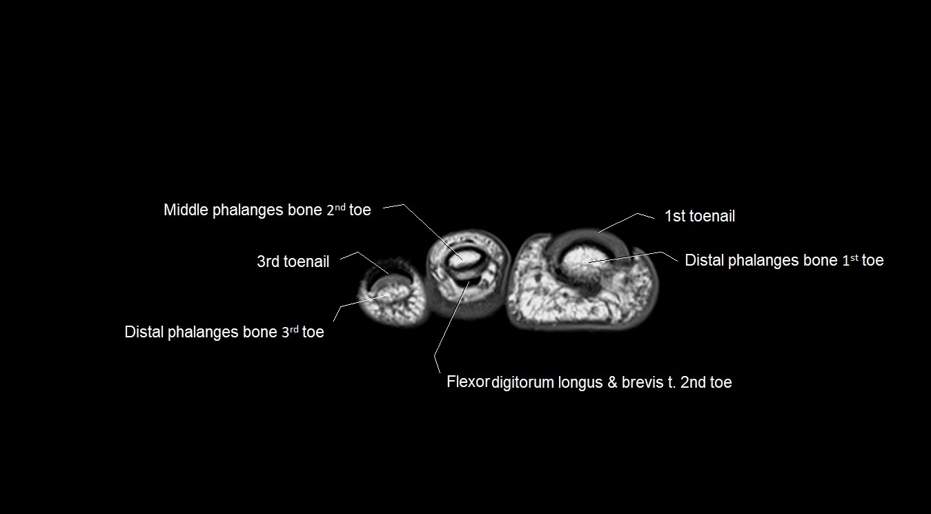 MRI 3T foot axial cross sectional anatomy image 41.webp